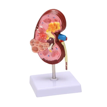 Модел на Заболяване на бъбреците Анатомия на Човешкото Тяло са Точно Копие на Болни Бъбреци За Кабинет Образователен Инструмент Анатомични Материали
